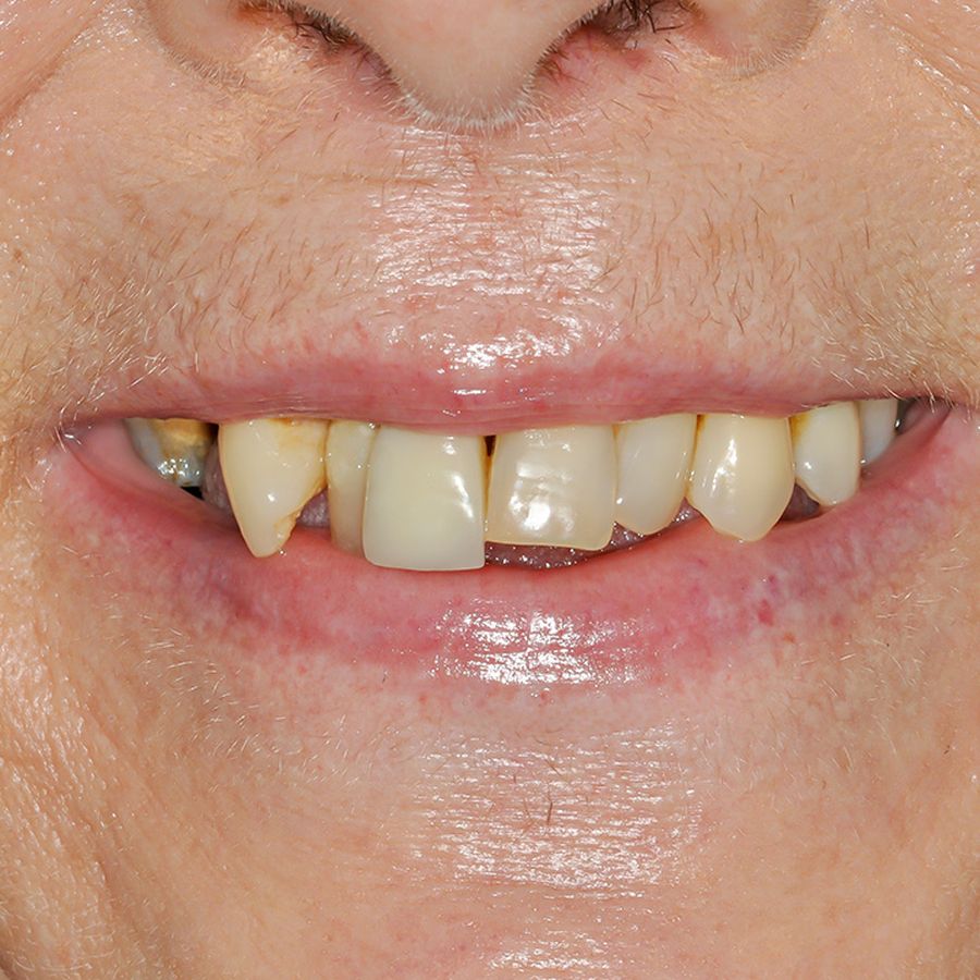 Before - Smile in a day - Dara Fahy - 3dental